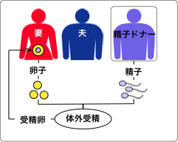 精子ドナープログラム(精子バンク利用)