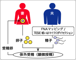 高度男性不妊治療プログラム(自己精子)